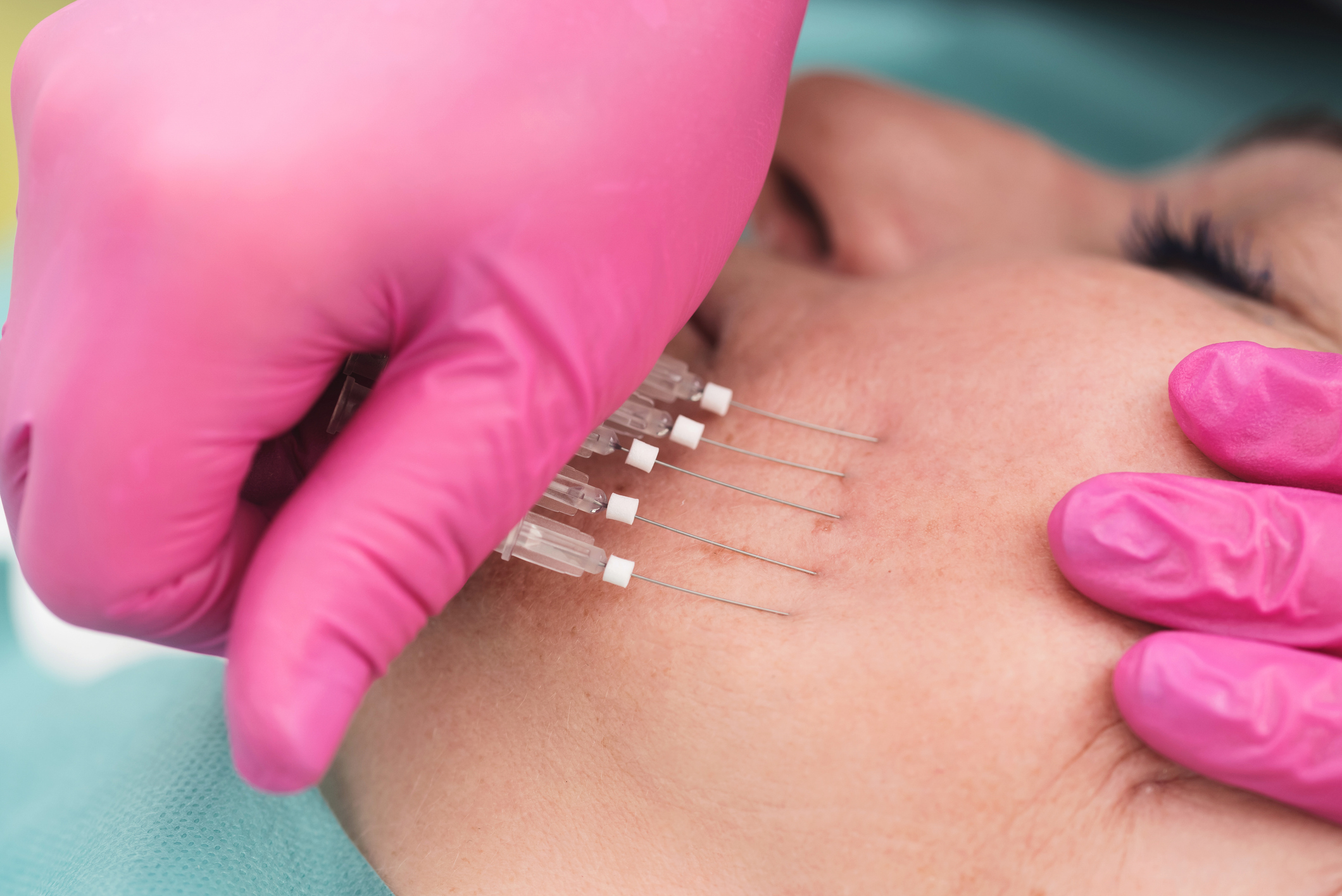 Botox treatment